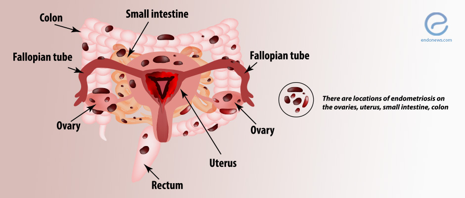 what is endometriosis